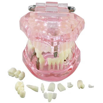 Възстановяване на Зъбни импланти Typodont Зъби Модел на Зъба M2001 Розов Цвят Демо Патология на устната Кухина Мост Обучение Проучване