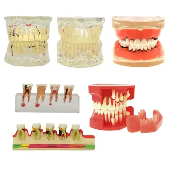 Стоматологичен Патологична Типодонт Модел на Зъбите, Пародонта /Имплантиране/Эндодонтический Кариес стоматологичен одонтология